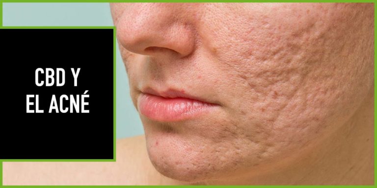 CBD-y-acne CBD y Acné