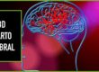 cbd ictus