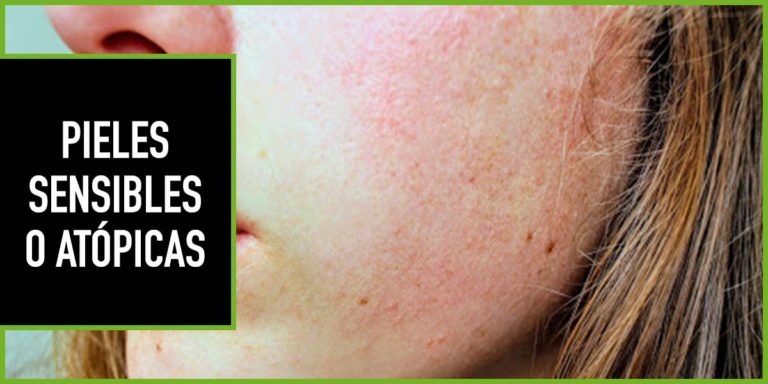 pieles-sensibles-atopicas pieles sensibles o atopicas con cbd